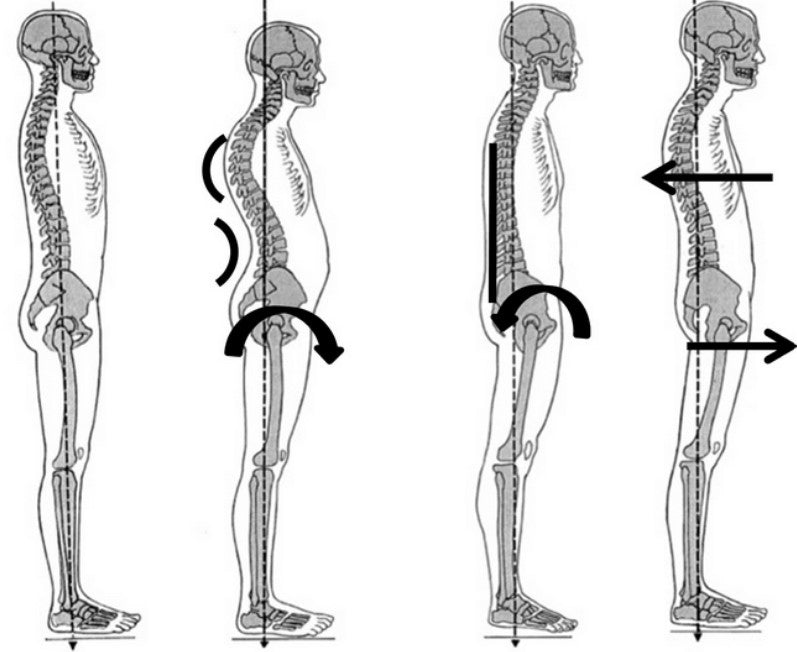 Ideal posture compared to problem postures